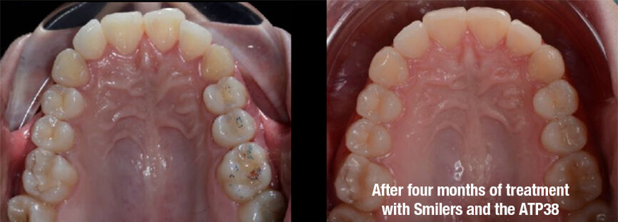 Fig. 3: Before (left) and after (right). The case was solved over four months with 16 clear aligners (Smilers) and photobiomodulation therapy (with the ATP38), applied every week for six minutes every time aligners were changed.