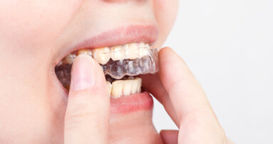 Nuovo rivestimento per prevenire la proliferazione batterica sugli apparecchi ortodontici