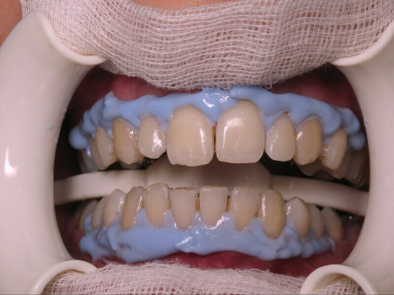 Figura 2. Protección de tejidos blandos durante un procedimiento de blanqueamiento dental en consultorio.