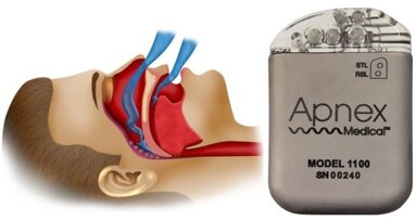 Un neurostimulateur semblable à un stimulateur cardiaque, pour éviter l'apnée du sommeil