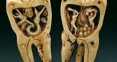 L’origine del mal di denti e la nascita della devitalizzazione