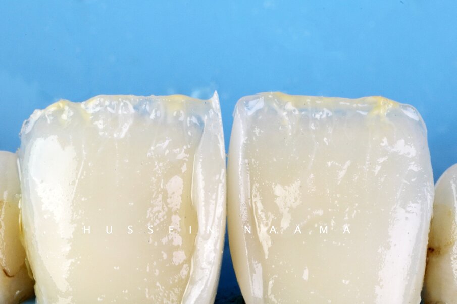 Fig. 11: Characterization of incisal area with Lite Art internal stains # Yellow & White.