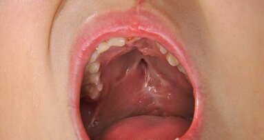 New study aims to understand genetic synergy in cleft palate