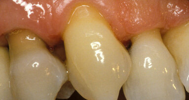 L’ipersensibilità dentinale un problema fastidioso