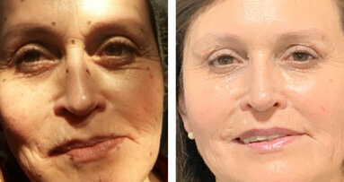 Armonización y rejuvenecimiento facial