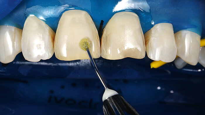 Fig. 14: A light-curing one-component adhesive was applied to the tooth surfaces.
