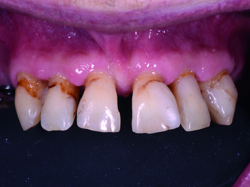 Fig. 3 : Vue préopératoire détaillée des dents antérieures supérieures.