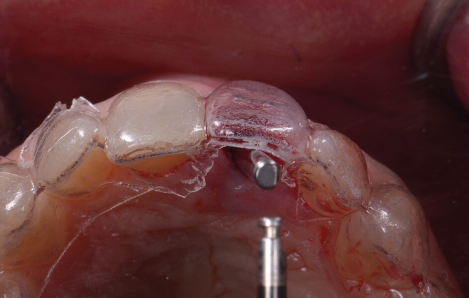 Fig. 12b : Un second guide fabriqué sur la base du wax-up diagnostique. La morphologie de la dent et le profil d’émergence ont été reproduits et servent de référence pour le positionnement de l’implant. (a et b). 