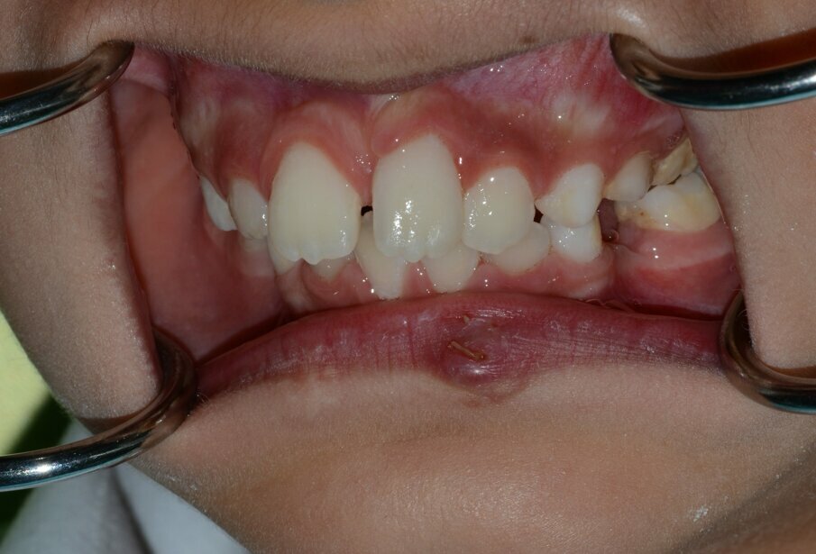 Figure 13: One-month post op after removal of the splint. The tooth was responsive to EC & EPT.