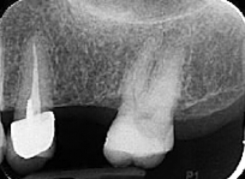 Fig. 35 : Région molaire édentée avant l’implantation. 