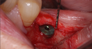 Vertical reconstruction of peri-implant soft tissue
