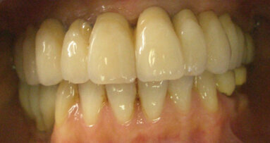 Intraoral welding and lingualized (lingual contact) occlusion: A case report