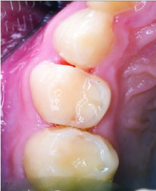 Figure 6: The Hall technique: tooth 54 with sufficient space after orthodontic separator removal