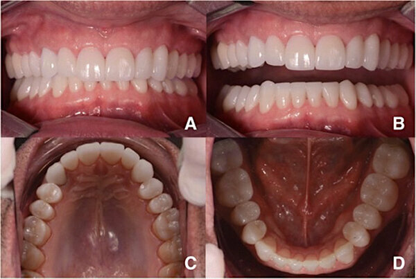 Fig. 14. Fotografías intraorales del tratamiento finalizado. a y b Vista frontal. c Vista oclusal de la mandíbula superior. d Vista oclusal de la mandíbula inferior.