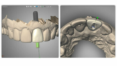 Digital dentistry: Three steps to enhance your dental implant laboratory