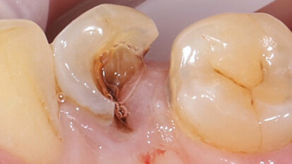 Fig. 1. Situación inicial: el diente 34 estaba fuertemente dañado. La encía se había adentrado en la cavidad.
