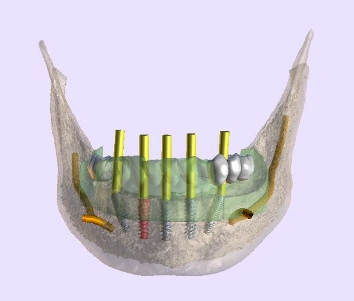 Fig. 9: Osteotomy drilling guide seated on the mandible.