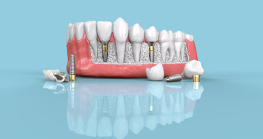 Dentsply Sirona announces comprehensive restage of its implant business