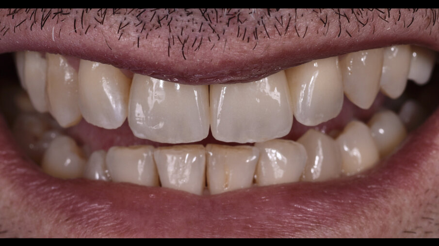 Figg. 17, 18_Armonia delle nuove forme e il rapporto dei denti con le labbra del paziente.