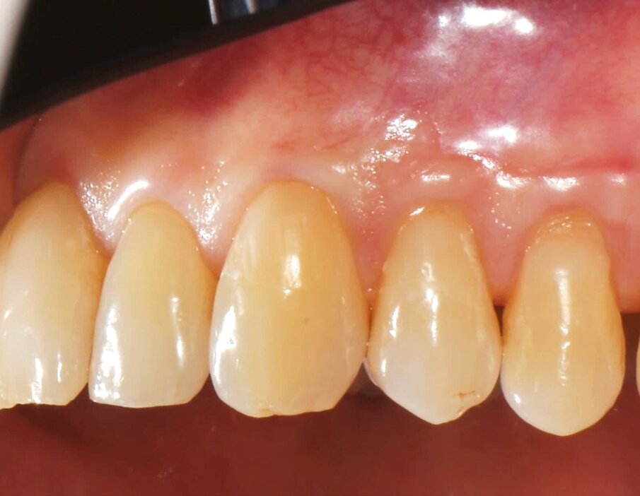 Fig. 8 - Controllo della guarigione a 1 anno: il sito trattato non presenta disarmonie cromatiche e di spessore in corrispondenza della mucosa orale.
