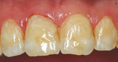 Caries removal and esthetic direct composite restorations