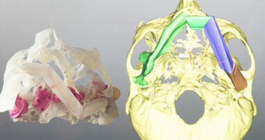 3-D-printed models revolutionise oral and maxillofacial surgery