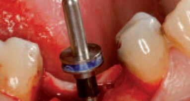 Zastosowanie implantu C1 – opis przypadku