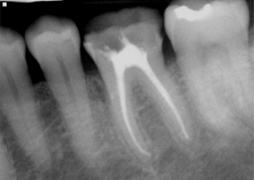 Fig. 17: Instrumentation was performed with ExactTaperH DC files and single cone obturation with Bioceramic Root Canal sealer completing the endodontic treatment preserving the cervical tooth structure during the treatment. 