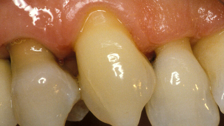 L’ipersensibilità dentinale un problema fastidioso