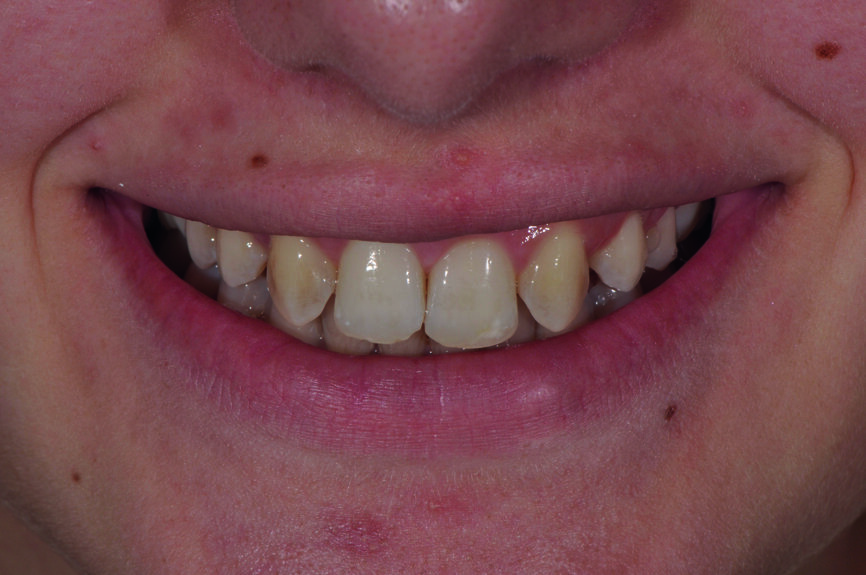 Fig. 1a : Sourire après la fermeture orthodontique. 