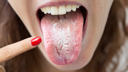 « Langue Covid » - les dentistes sont invités à rester attentifs aux symptômes de la cavité buccale