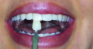 Update on tooth whitening and remineralisation with nHAp