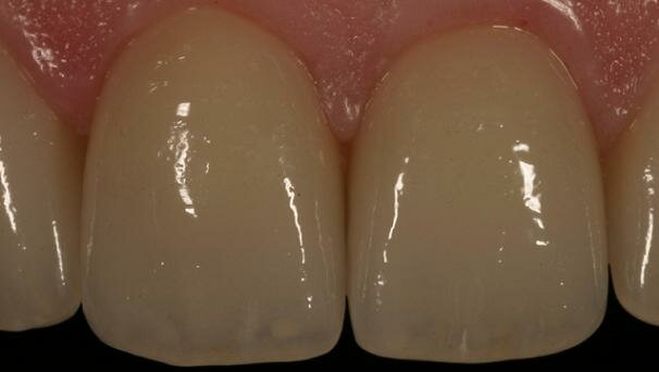 Lithium disilicate, the restorative material of multiple options
