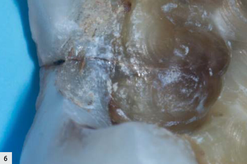 Figs. 6–7 : Fissure dans la boîte proximale, devenue plus apparente après l’élimination de la boue dentinaire. 