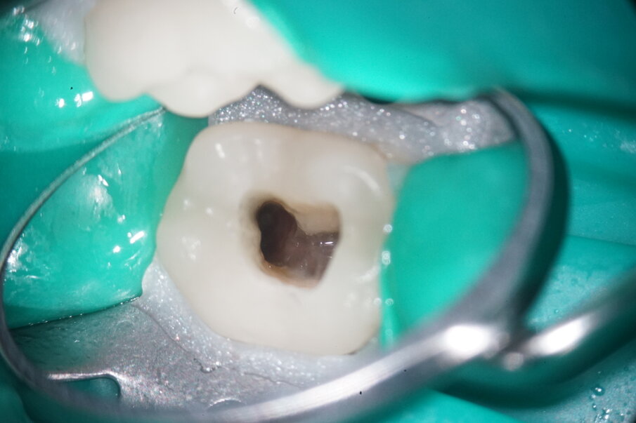 Fig. 9: Final preparation distally.