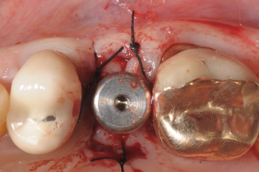 Fig. 5 - Dopo l’inserimento implantare si procede ad un piccolo prelievo connettivale da posizionare in sede vestibolare, fissato con punti staccati di sutura acrilica in Nylon 5/0.