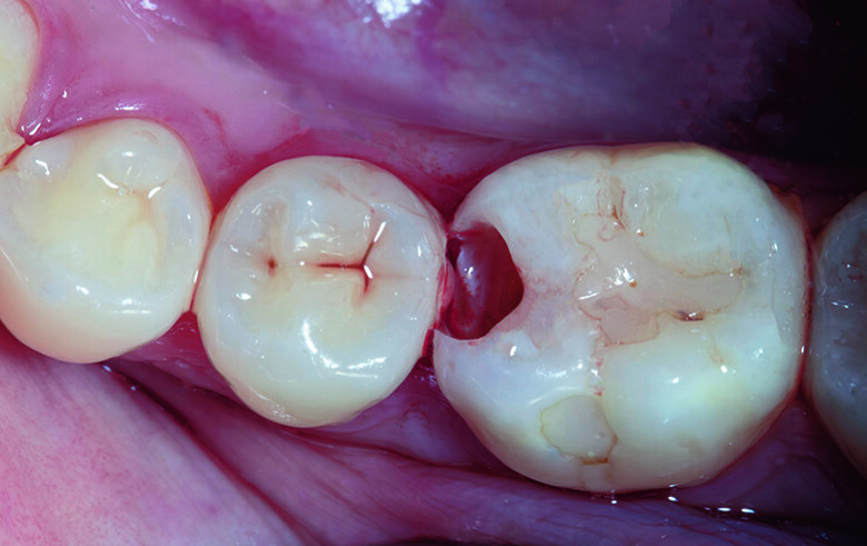 Fig. 1. MO Class II cavity along with old composite restoration on tooth #46 and distal decay on tooth #45.