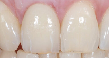 Immediate placement and temporization with a titanium-zirconium dental implant