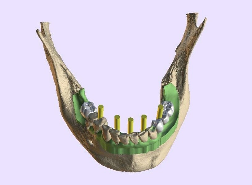 Fig. 6d: Yellow abutment projections representing screw access channels.