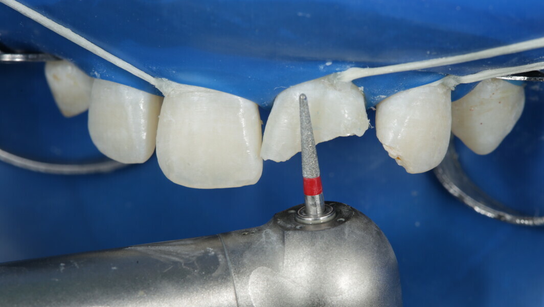 Fig 9: Using fine grit bur all unsupported enamel was removed and 2mm short bevel was given.