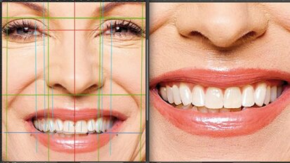 Aesthetic Digital Smile Design ADSD : dentisterie esthétique assistée par ordinateur – Partie II