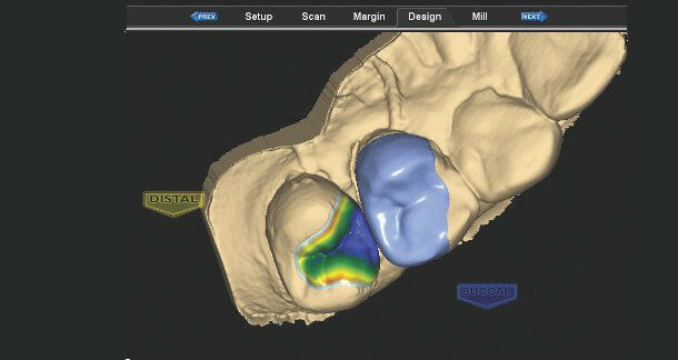 Computer-aided crown design – Fabrication of CAD/CAM crowns chairside