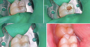 Avantages de l’utilisation du laser Er:YAG chez les patients ayant des besoins spéciaux. Dentisterie conservatrice: étude clinique
