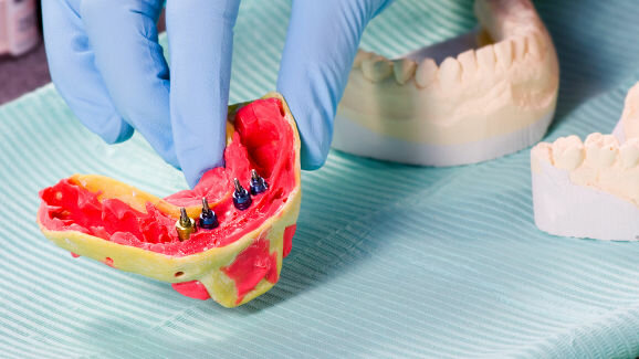 Comitê FDA confirma a queda na classificação dos implantes dentários