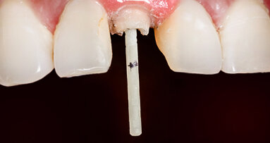 CAD/CAM-integrated glass fibre post and core restoration improves tooth fracture strength