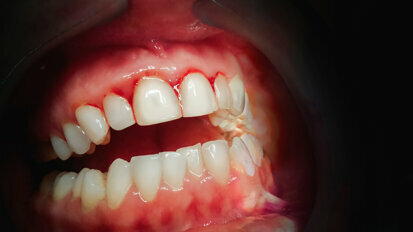 Researchers find possible link between bruxism and periodontitis
