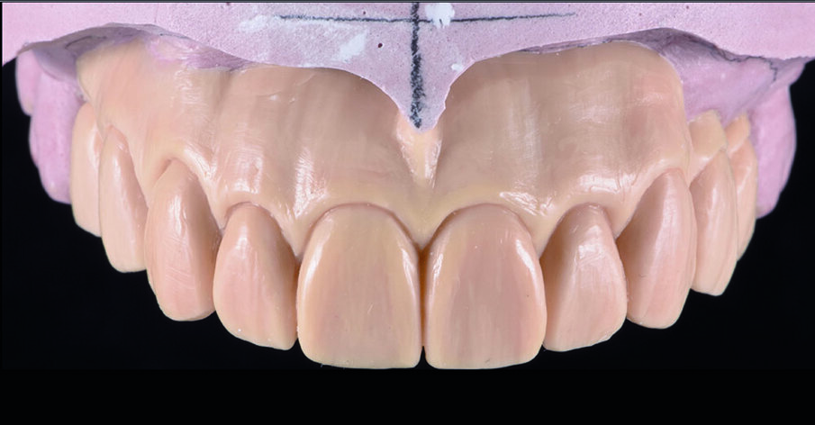 Fig 8. Full-contour waxing was made according to teeth proportion and position.