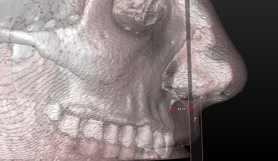 Fig. 11_Valutazione dei tessuti molli: spessore del labbro coronale.