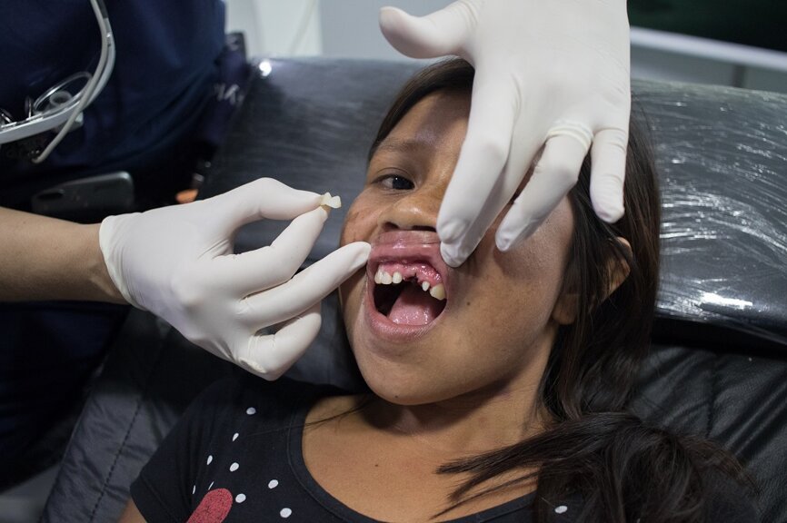 Paciente jovem com dente faltando na posição 11. (Fotografia: Dentsply Sirona)