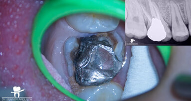 Autogenous transplantation followed by conservative root canal therapy: Three years follow-up